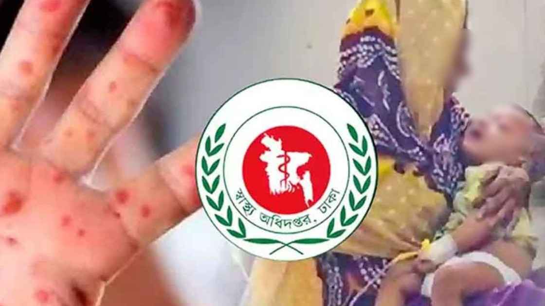 ২৪ ঘণ্টায় হামের উপসর্গে ৮ শিশুর মৃত্যু